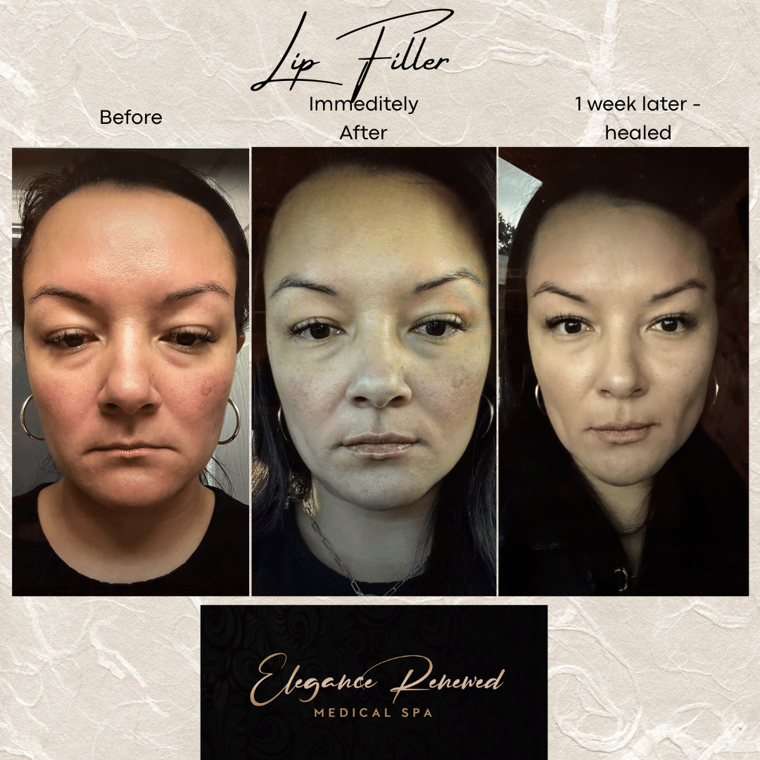 Before and After Image: Lip Filler - front
