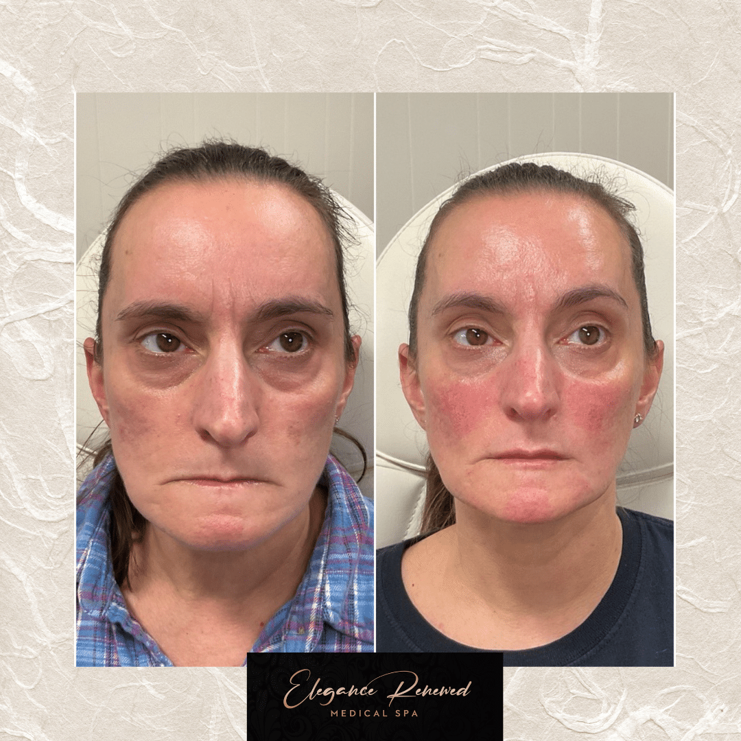 Before and After Image: Full Face Filler Treatment - front
