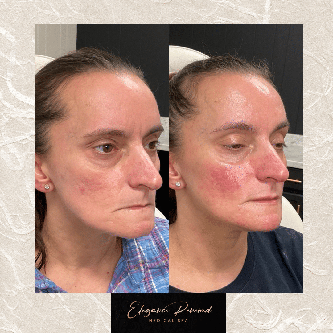 Before and After Image: Full Face Filler Treatment - right-front-oblique