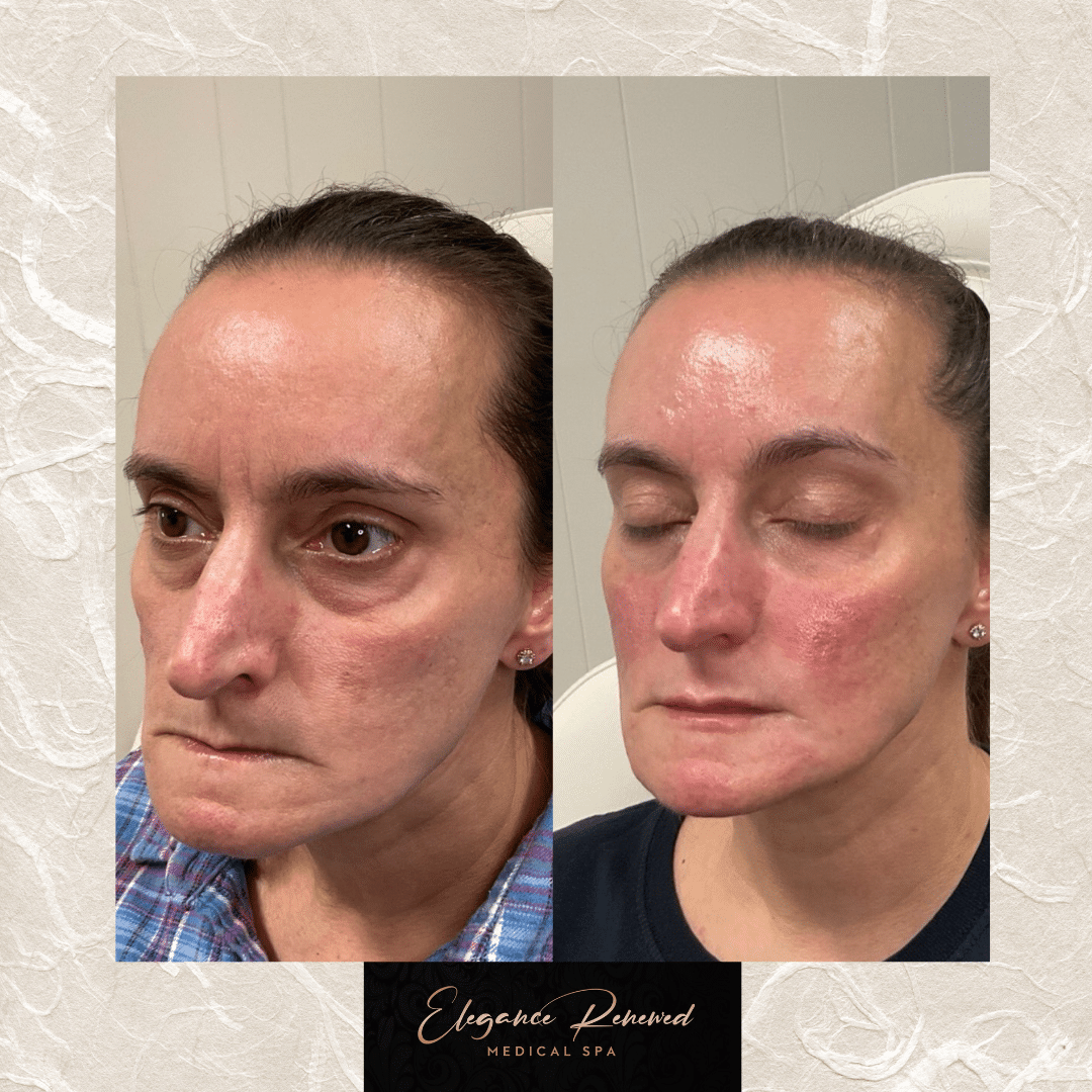 Before and After Image: Full Face Filler Treatment - left-front-oblique