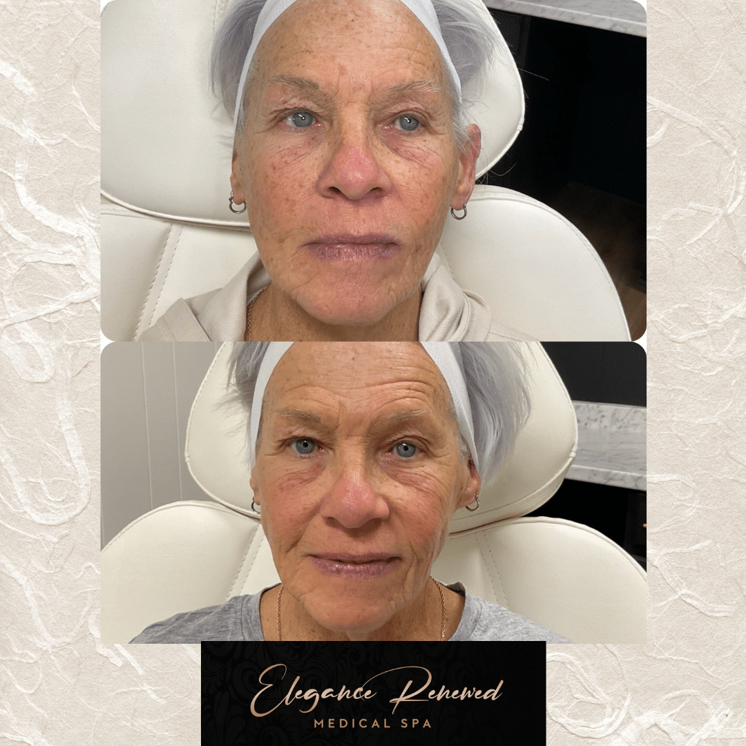 Before and After Image: Chemical Peel - front