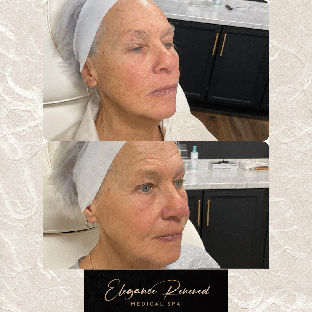 Before and After Image: Chemical Peel - right-front-oblique